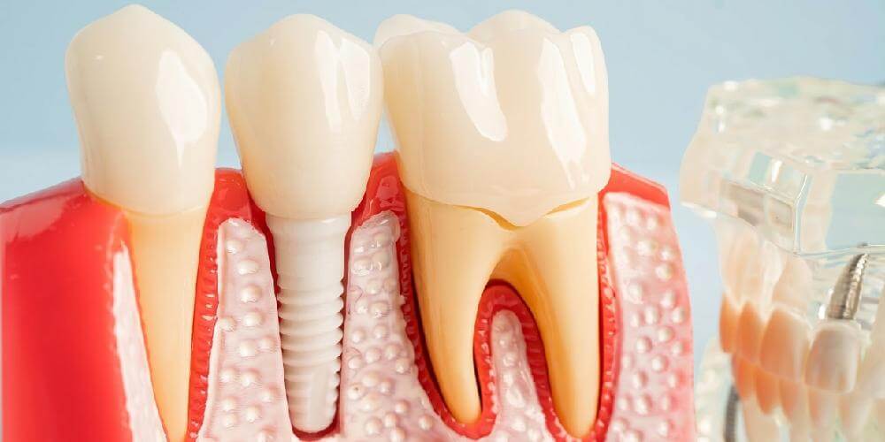 Ceramic Dental Implants Newport Beach