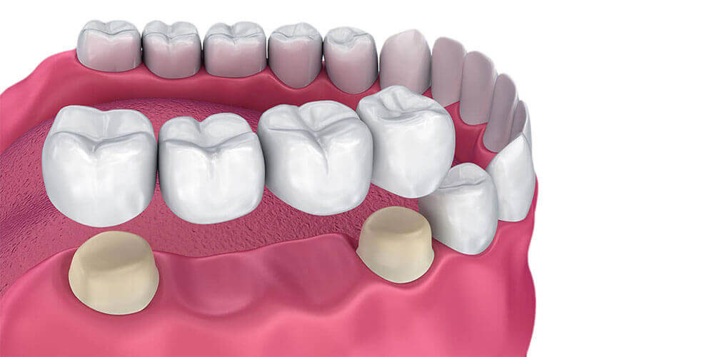 Dental Bridges Newport Beach