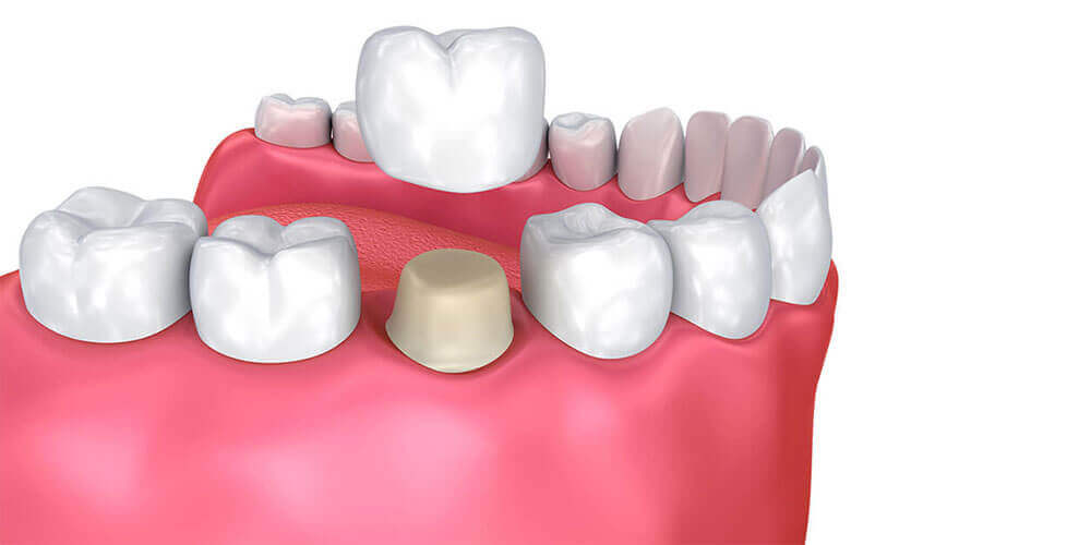 Dental Crowns Newport Beach