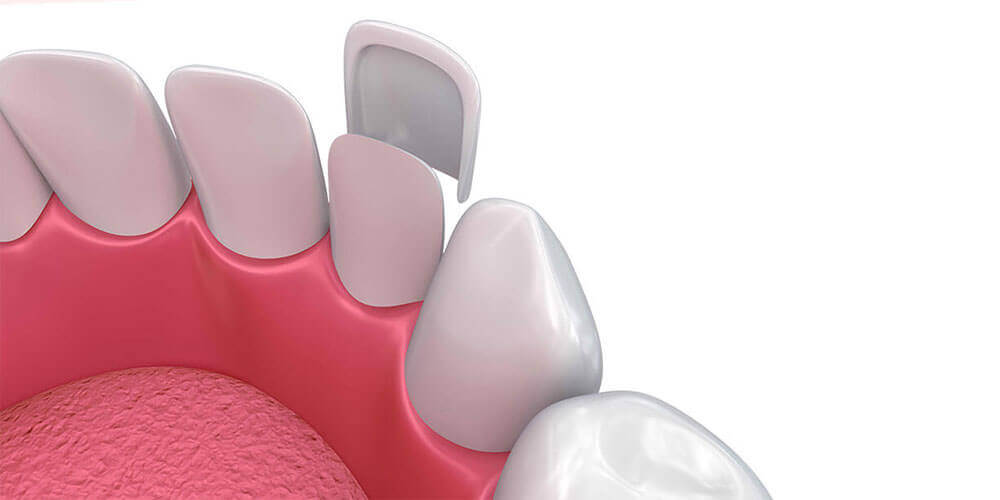 Dental Veneers Newport Beach